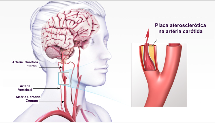 Fique atento aos sinais do infarto - Circular Cirurgia Vascular